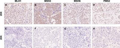 Clinicopathological characteristics and loss of mismatch repair protein expression in Chinese upper tract urothelial carcinomas